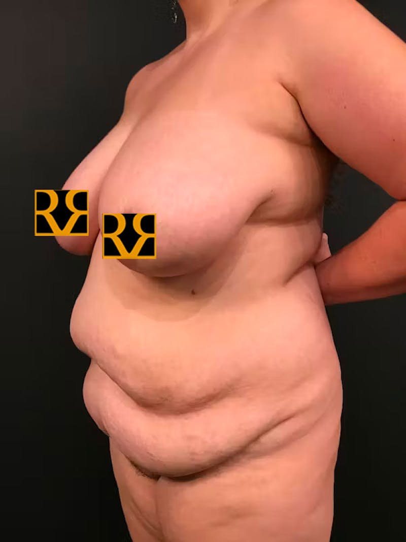 Plus Size Tummy Tuck ® Before & After Gallery - Patient 531490 - Image 3