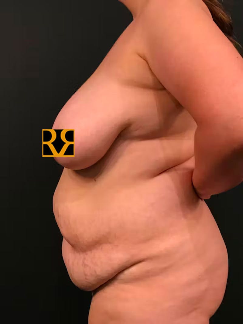 Plus Size Tummy Tuck ® Before & After Gallery - Patient 531490 - Image 5