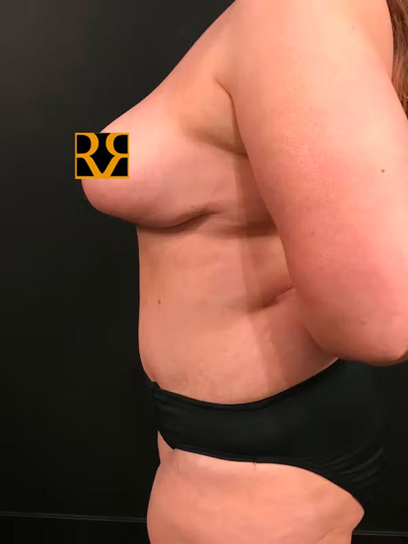 Plus Size Tummy Tuck ® Before & After Gallery - Patient 531490 - Image 6