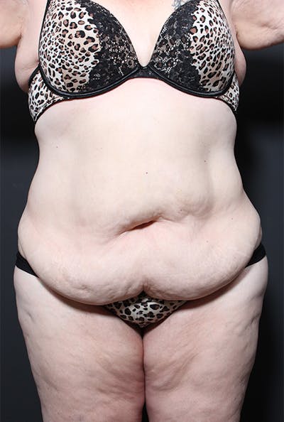 Plus Size Tummy Tuck ® Before & After Gallery - Patient 151608 - Image 1