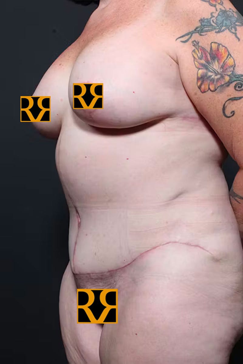 Plus Size Tummy Tuck ® Before & After Gallery - Patient 265441 - Image 4