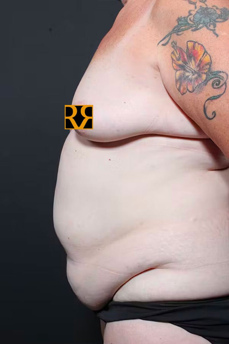 Plus Size Tummy Tuck ® Before & After Gallery - Patient 265441 - Image 5