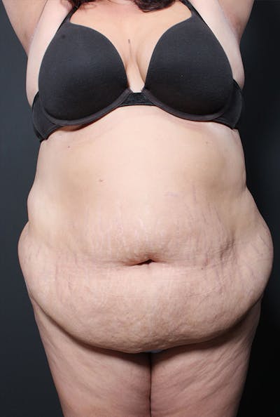 Plus Size Tummy Tuck ® Before & After Gallery - Patient 400823 - Image 1