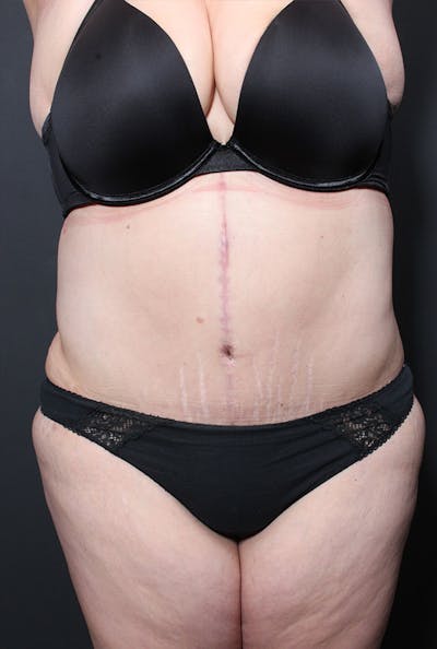 Plus Size Tummy Tuck ® Before & After Gallery - Patient 400823 - Image 2