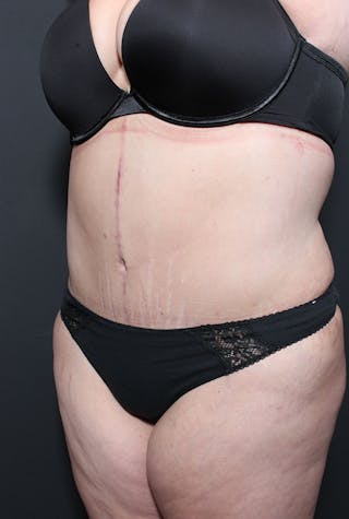 Plus Size Tummy Tuck ® Before & After Gallery - Patient 400823 - Image 4