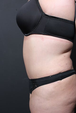 Plus Size Tummy Tuck ® Before & After Gallery - Patient 400823 - Image 6