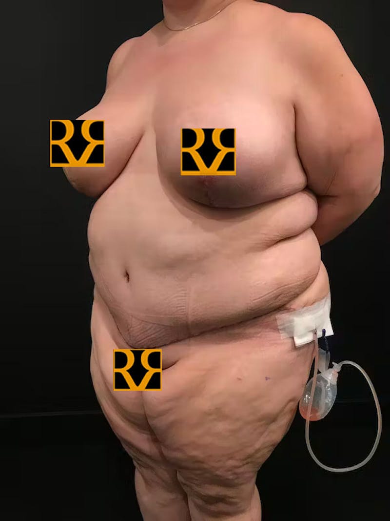 Plus Size Tummy Tuck: Week After Surgery Before & After Gallery - Patient 215289 - Image 4