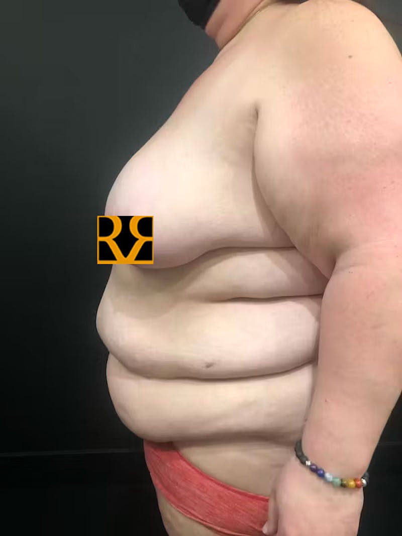 Plus Size Tummy Tuck: Week After Surgery Before & After Gallery - Patient 215289 - Image 5