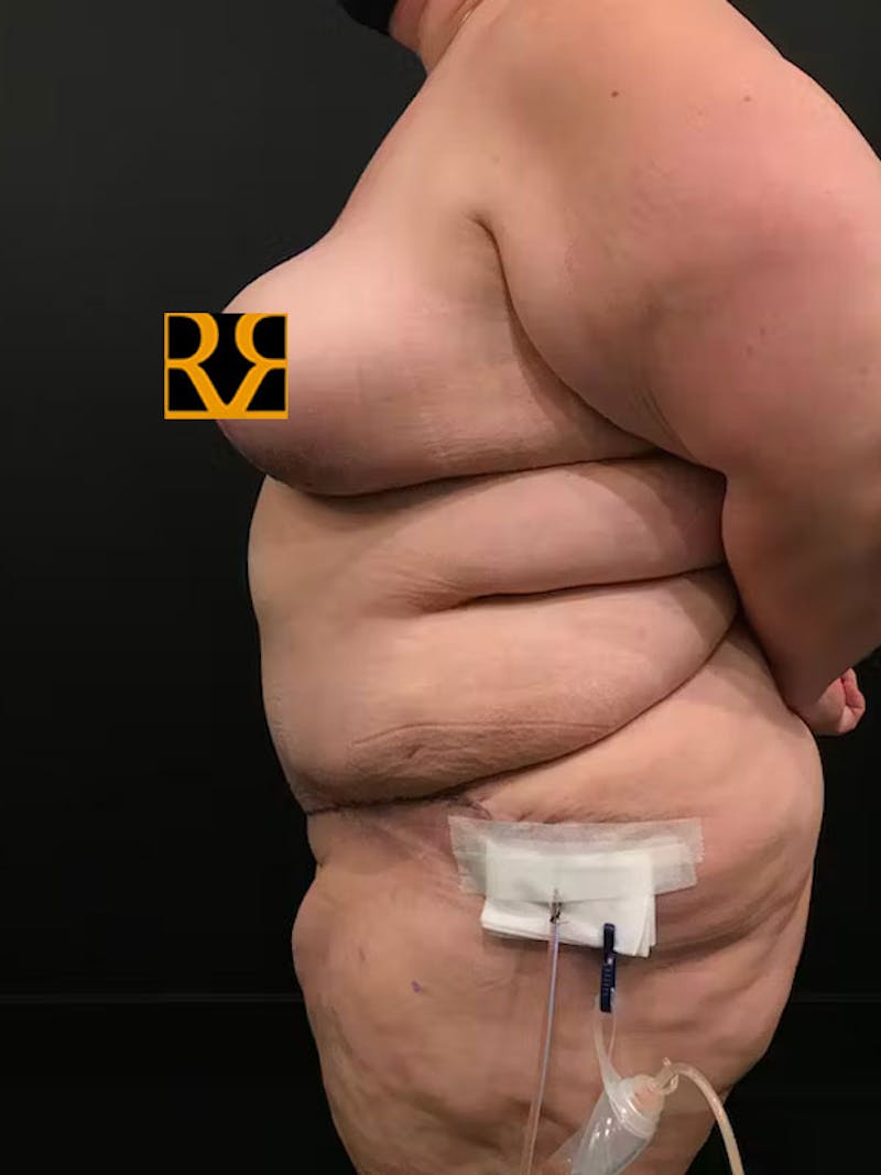 Plus Size Tummy Tuck: Week After Surgery Before & After Gallery - Patient 215289 - Image 6