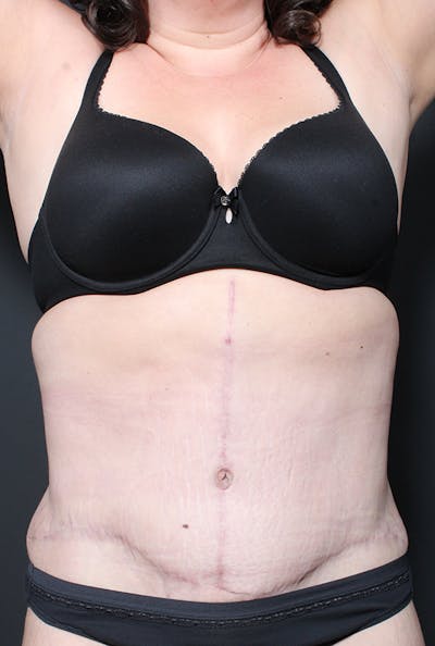 Plus Size Tummy Tuck ® Before & After Gallery - Patient 277766 - Image 2