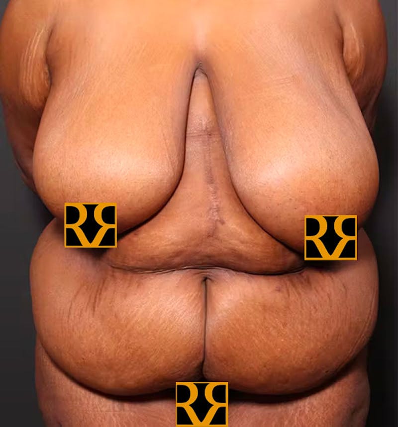 Plus Size Tummy Tuck ® Before & After Gallery - Patient 280374 - Image 1
