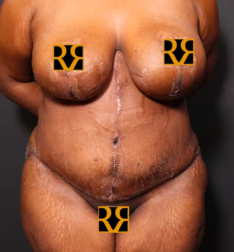 Plus Size Tummy Tuck ® Before & After Gallery - Patient 280374 - Image 2