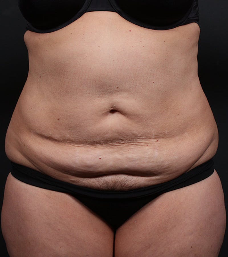 Tummy Tuck Before & After Gallery - Patient 194084 - Image 1