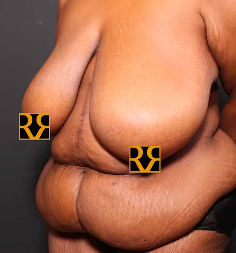 Plus Size Tummy Tuck ® Before & After Gallery - Patient 280374 - Image 3