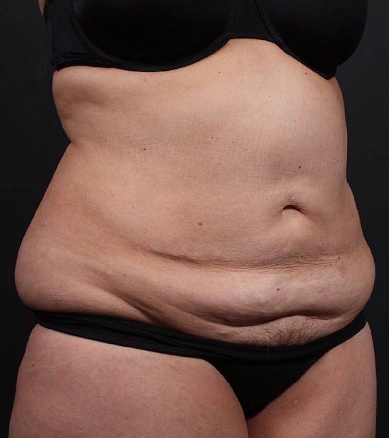 Tummy Tuck Before & After Gallery - Patient 194084 - Image 3