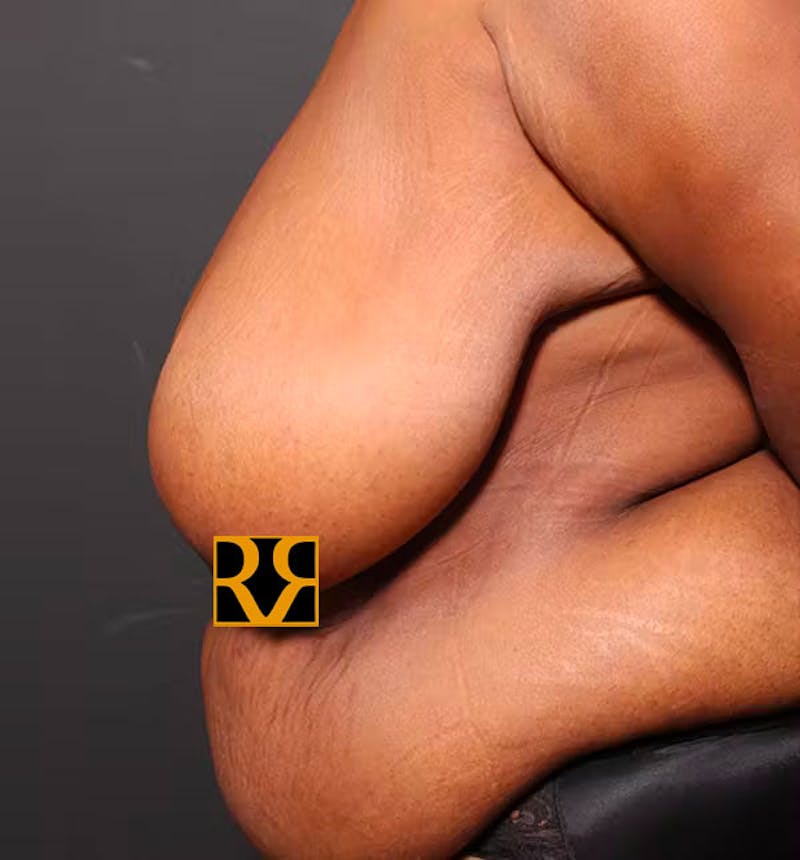 Plus Size Tummy Tuck ® Before & After Gallery - Patient 280374 - Image 5