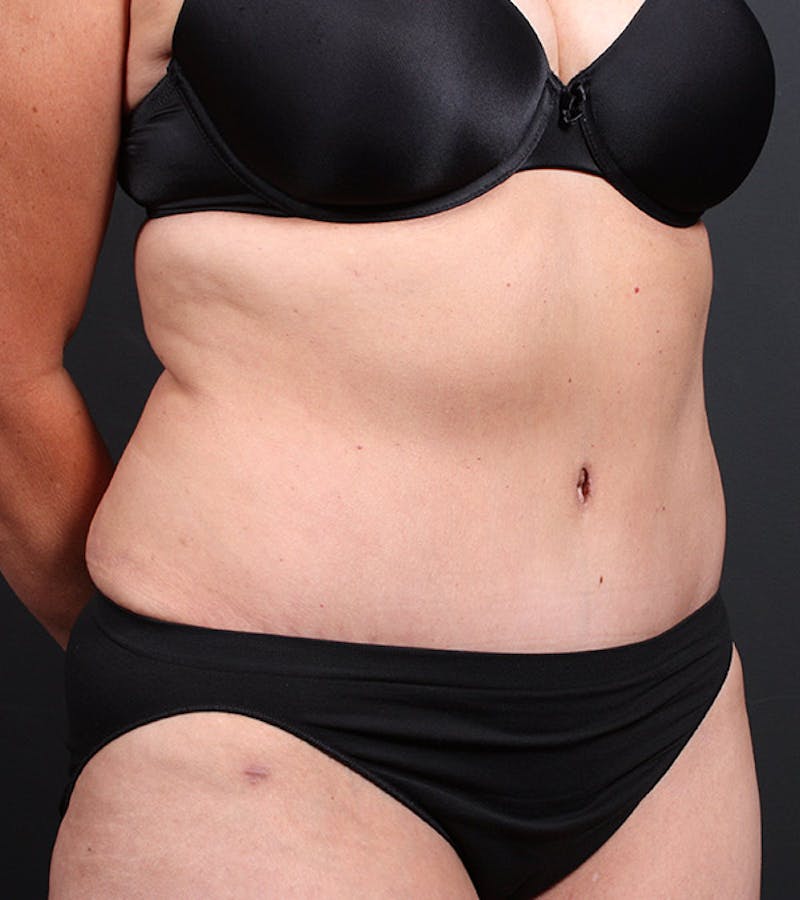 Tummy Tuck Before & After Gallery - Patient 194084 - Image 4