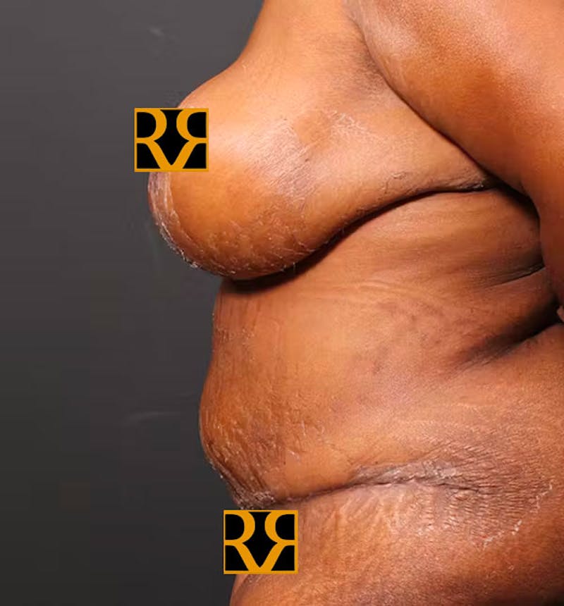 Plus Size Tummy Tuck ® Before & After Gallery - Patient 280374 - Image 6