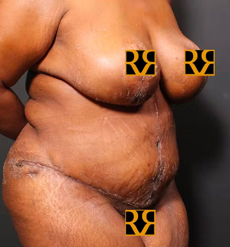 Plus Size Tummy Tuck ® Before & After Gallery - Patient 280374 - Image 8