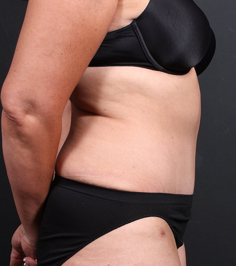 Tummy Tuck Before & After Gallery - Patient 194084 - Image 6