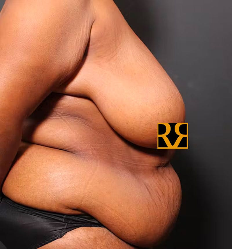 Plus Size Tummy Tuck ® Before & After Gallery - Patient 280374 - Image 9