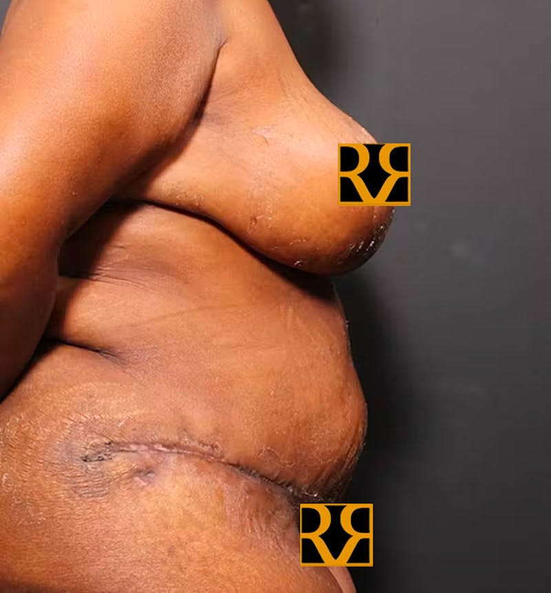 Plus Size Tummy Tuck ® Before & After Gallery - Patient 280374 - Image 10