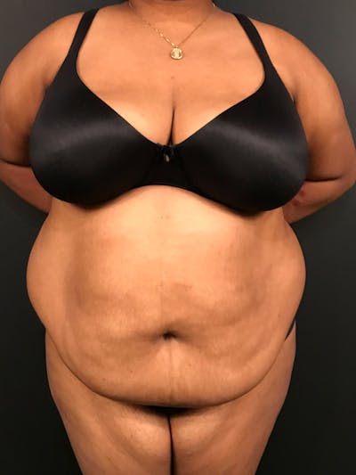Plus Size Tummy Tuck ® Before & After Gallery - Patient 199708 - Image 1