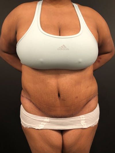 Plus Size Tummy Tuck ® Before & After Gallery - Patient 199708 - Image 2