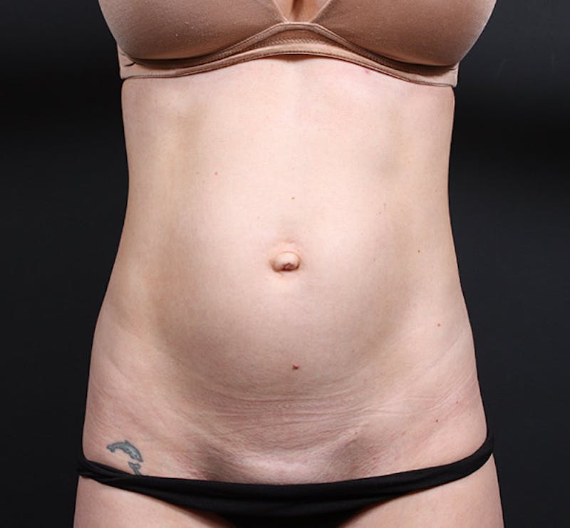 Tummy Tuck Before & After Gallery - Patient 363115 - Image 1