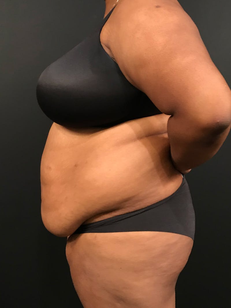 Plus Size Tummy Tuck ® Before & After Gallery - Patient 199708 - Image 5