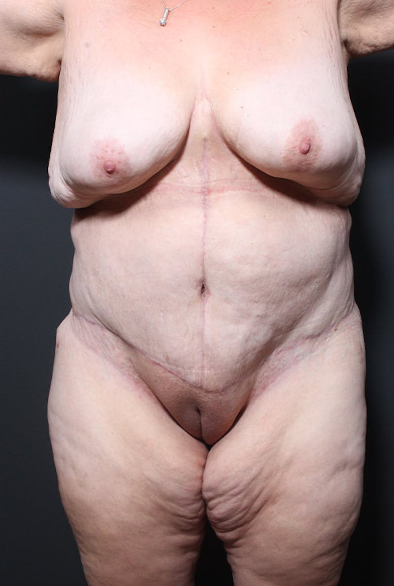 Tummy Tuck Before & After Gallery - Patient 139360 - Image 2