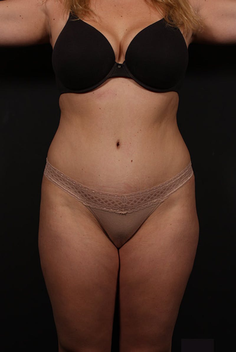 Tummy Tuck Before & After Gallery - Patient 759405 - Image 1
