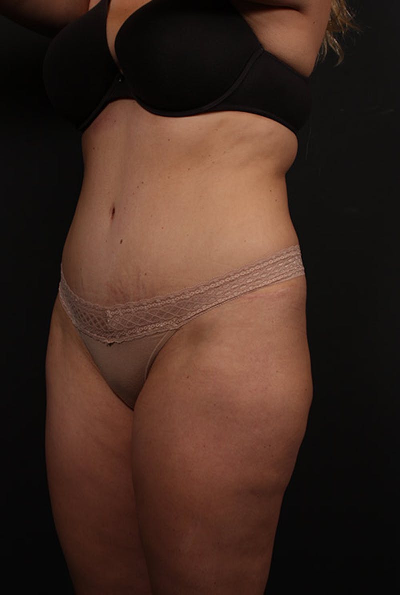 Tummy Tuck Before & After Gallery - Patient 759405 - Image 3