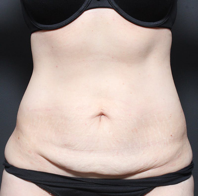 Tummy Tuck Before & After Gallery - Patient 131555 - Image 1