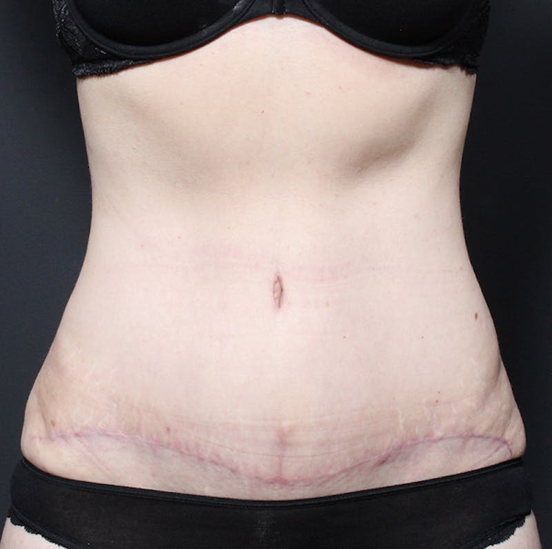 Tummy Tuck Before & After Gallery - Patient 131555 - Image 2
