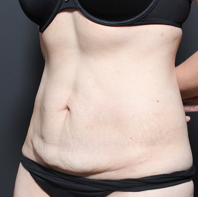 Tummy Tuck Before & After Gallery - Patient 131555 - Image 3