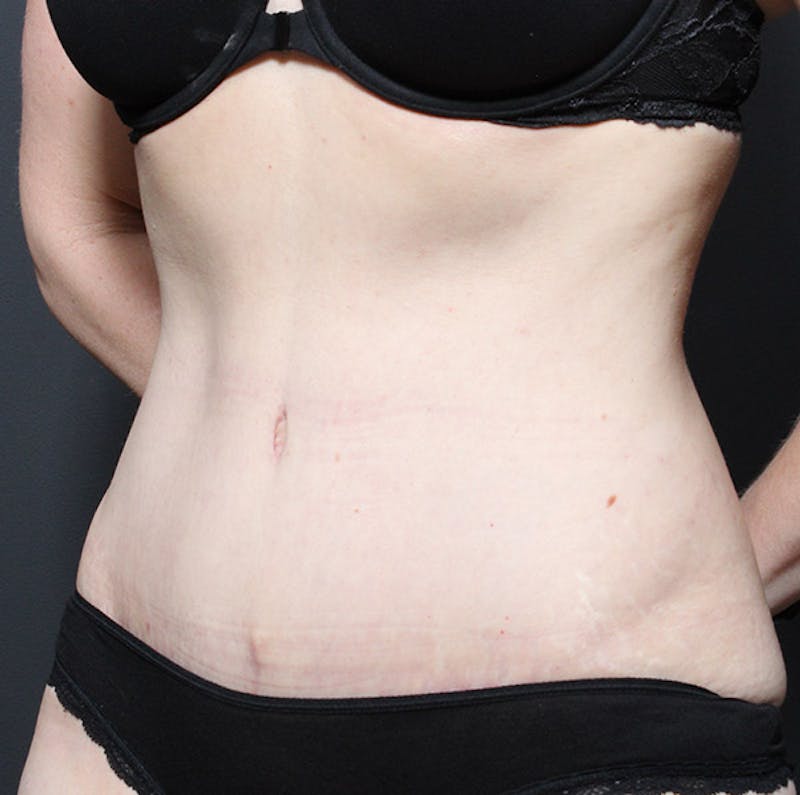 Tummy Tuck Before & After Gallery - Patient 131555 - Image 4