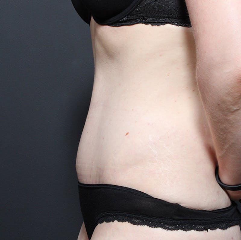 Tummy Tuck Before & After Gallery - Patient 131555 - Image 6