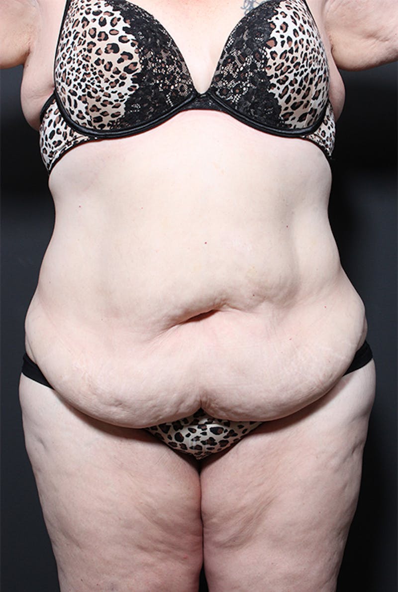Tummy Tuck Before & After Gallery - Patient 152305 - Image 1
