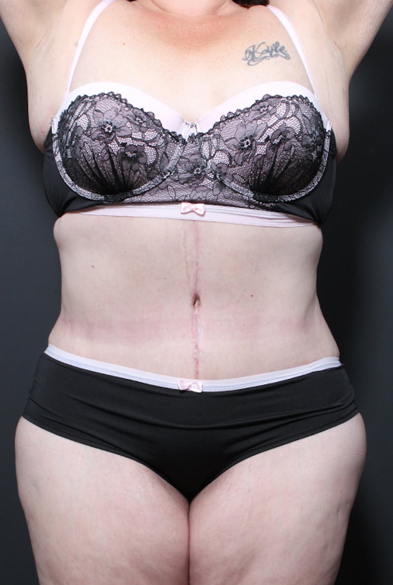 Tummy Tuck Before & After Gallery - Patient 152305 - Image 2