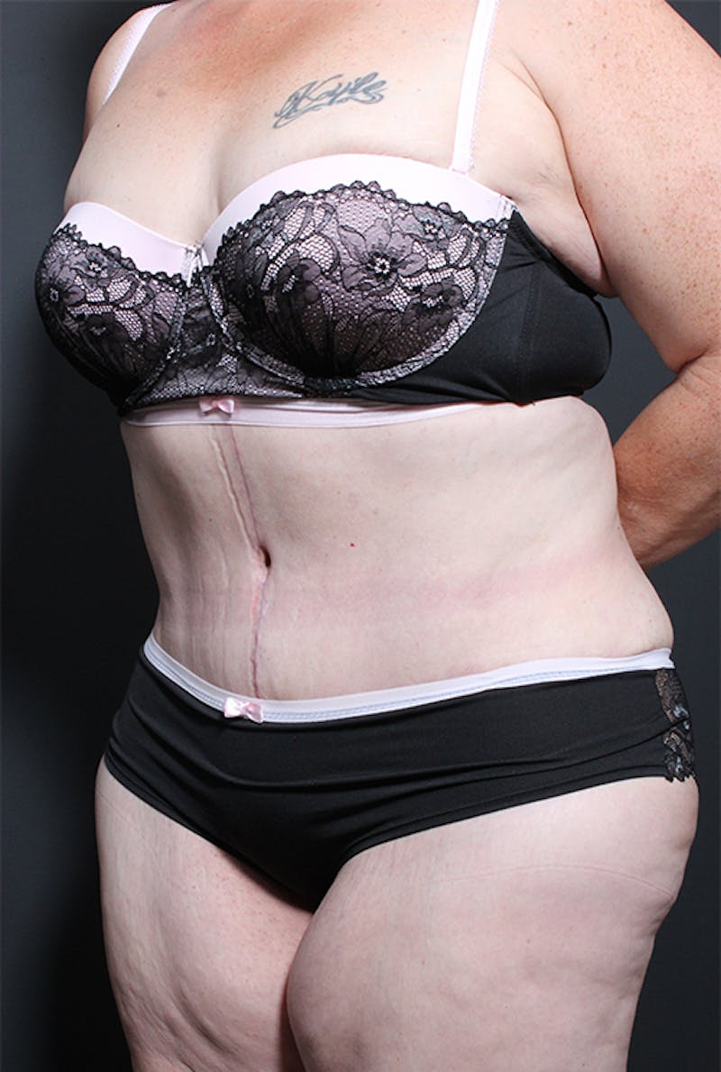 Tummy Tuck Before & After Gallery - Patient 152305 - Image 4