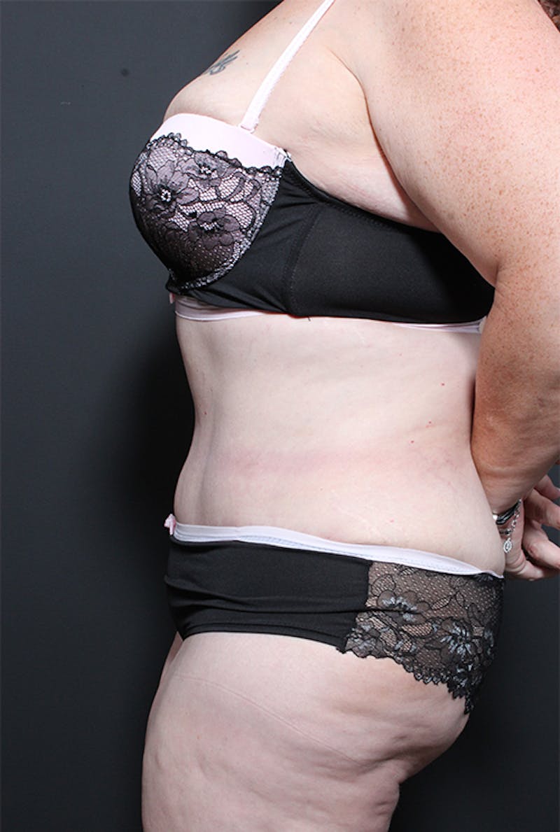 Tummy Tuck Before & After Gallery - Patient 152305 - Image 6