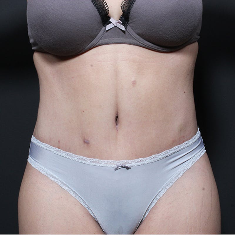 Tummy Tuck Before & After Gallery - Patient 182285 - Image 2