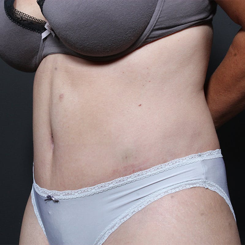 Tummy Tuck Before & After Gallery - Patient 182285 - Image 4