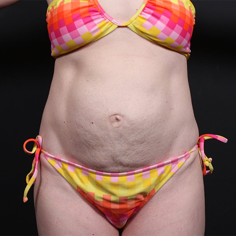 Tummy Tuck Before & After Gallery - Patient 151688 - Image 1