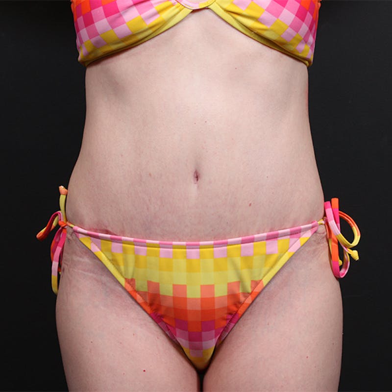 Tummy Tuck Before & After Gallery - Patient 151688 - Image 2