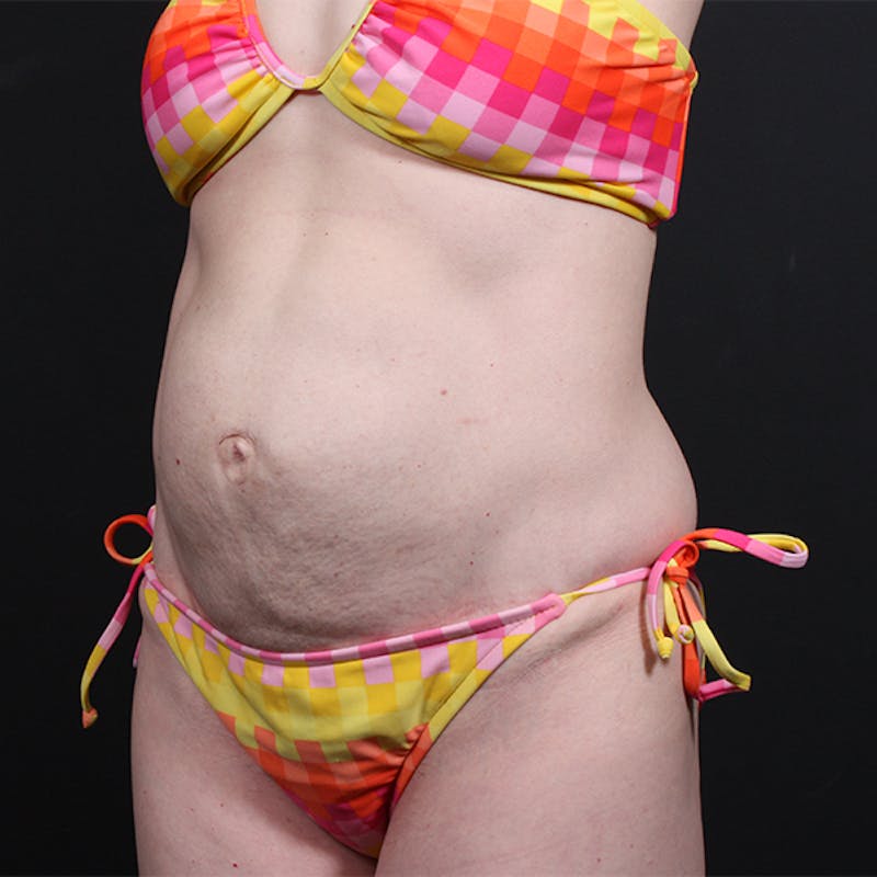 Tummy Tuck Before & After Gallery - Patient 151688 - Image 3