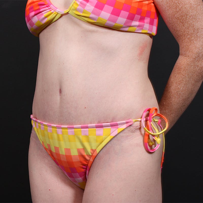 Tummy Tuck Before & After Gallery - Patient 151688 - Image 4