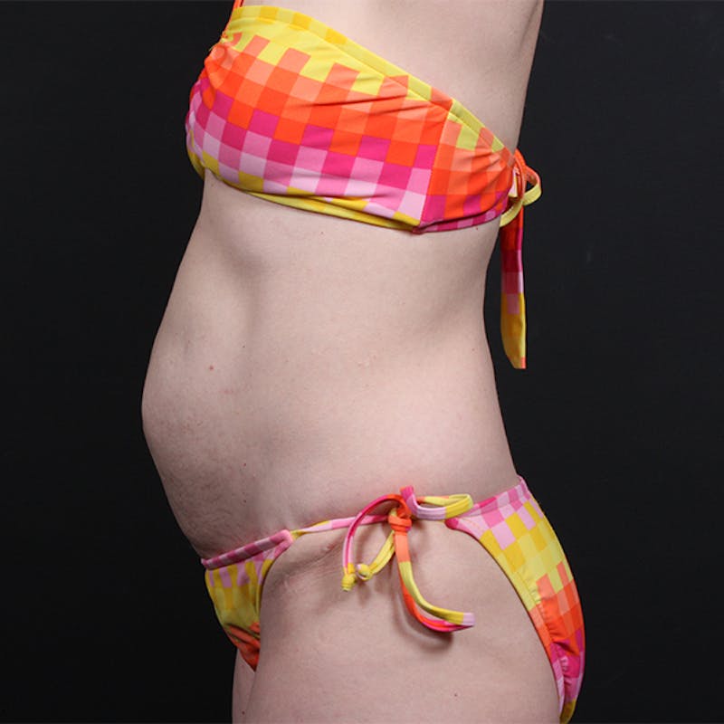 Tummy Tuck Before & After Gallery - Patient 151688 - Image 5