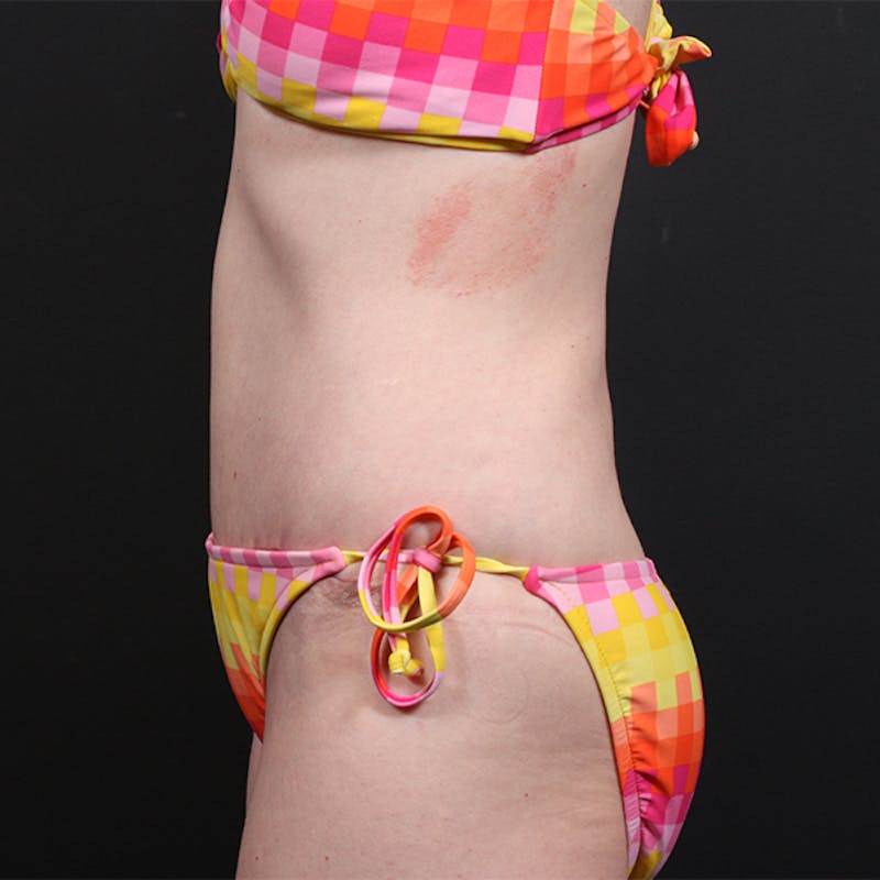 Tummy Tuck Before & After Gallery - Patient 151688 - Image 6